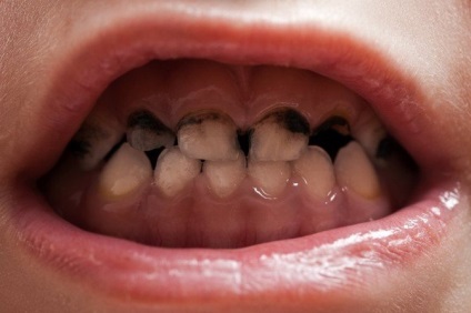 Fekete és sötét színű lepedék a fogakon a felnőttek és gyermekek okok és megoldások, megelőzés videó