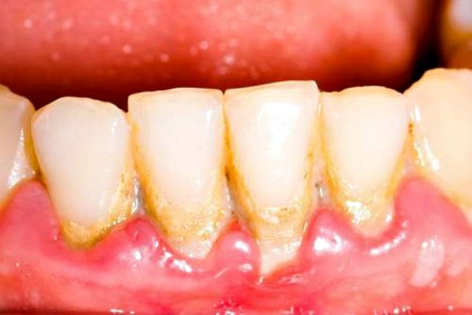 Cheshtutsya fogak és az íny kezelés, okai, tünetei, típusai, a diagnózis és megelőzés