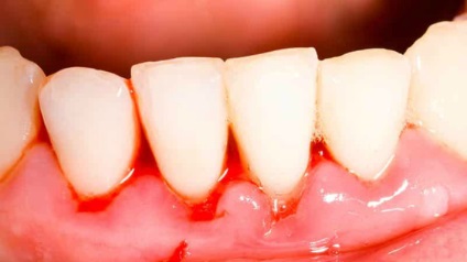 Cheshtutsya fogak és az íny kezelés, okai, tünetei, típusai, a diagnózis és megelőzés