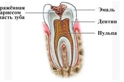 Mi a teendő, ha egy foga letört egy darab (csinál) Mi a teendő, ha egy foga letört egy darab
