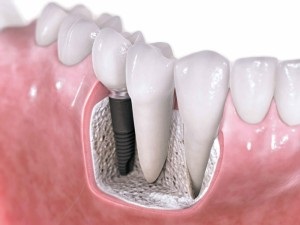 Mi a fogászati ​​implantátum, és mennyibe kerül, hogy azt