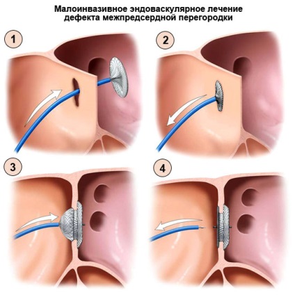 Pitvari septum defectus (ASD) gyermekeknél és felnőtteknél