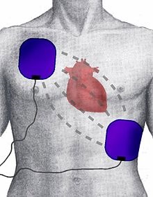 Defibrillátor - az