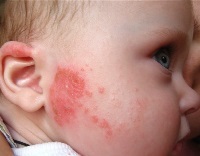 Dermatitis a gyermek arcát, dermatitis - mit és hogyan kell kezelni