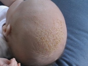 Dermatitis csecsemők