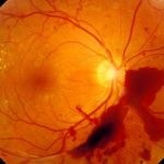 A diabéteszes retinopátia a cukorbetegség tünetei és kezelése, osztályozása és képek