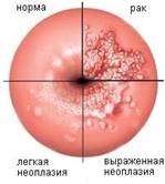 Diszplázia (neoplasia) méhnyak