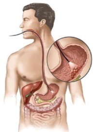 Pusztító gyomorhurut kezelésére - mik a lehetőségek (gastritis) Pusztító gyomorhurut kezelésére - mik a lehetőségek