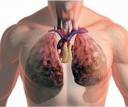 A tüdő-fibrózis kezelésére