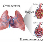 Fibro-barlangos tüdő tuberkulózis - okai, tünetei, kezelése
