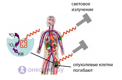 Fotodinamikus terápia, PDT az onkológiában, rák kezelésében