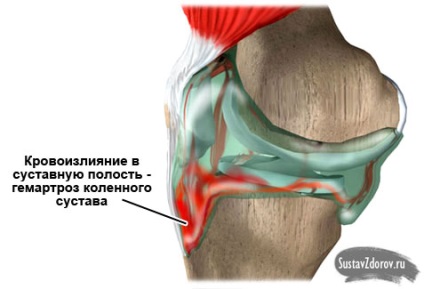haemathrosis a térd okoz, a tünetek, a kezelés és a megelőzés