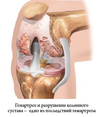 haemathrosis a térd okoz, a tünetek, a kezelés és a megelőzés