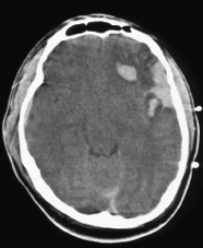 Haematoma stroke után - kezelés a szív