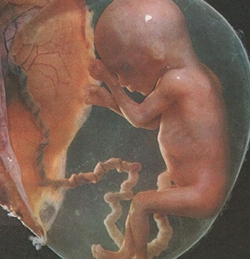 A mellékvese hiperplázia noduláris gömbgrafitos formában, a tünetek mind a férfiak és a nők, a kezelés (mellékvese) mellékvese hiperplázia noduláris gömbgrafitos formában, a tünetek mind a férfiak és a nők, a kezelés