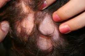 Alopecia areata kezeléssel és technikával (alopecia) Alopecia areata kezelésére és módszerek