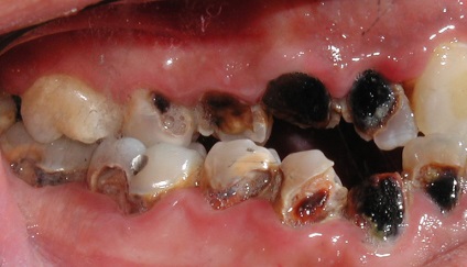 Rothadó fogak okok, kezelés, következményei és vezesse fogászat