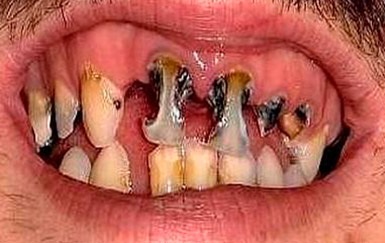 Rothadó fogak okok, kezelés, következményei és vezesse fogászat