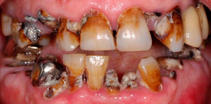 Rothadó fogak okok, kezelés, következményei és vezesse fogászat