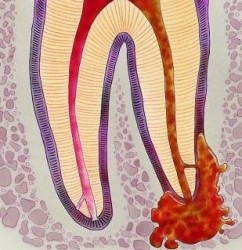 Granuloma - szól az egészségügyi (forró vizet, hogy ragaszkodjanak perc) Granuloma - szól az egészségügyi