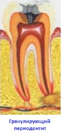 Granuláló periodontiíissei fő tünetek és a kezelési módszerek