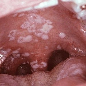 száj gombás fertőzése