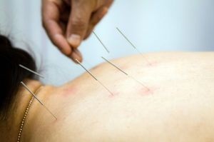 Akupunktúra osteochondrosis a nyaki gerinc, vélemények az előnyeit akupunktúra