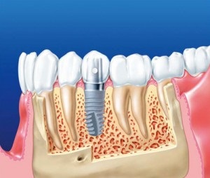 Az implantáció a fogak (implantátumok) (fog) Fogászati implantátumok (implantátumok)