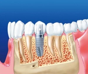 Fogászati ​​implantátumok (implantátumok)