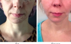 Botox injekciók (botox) Moszkva olcsó - klinika telo s szépséget