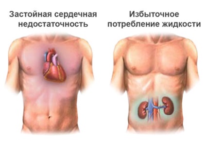 Az inzulinfüggő diabetes - mi ez, és hogyan működött