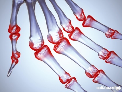 Hogyan lehet megszabadulni az arthritis