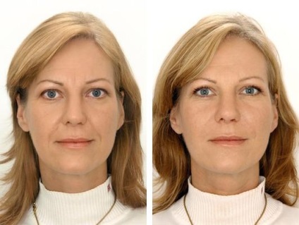 Hogyan lehet megszabadulni a arcon ráncok - 5 módon, hogy távolítsa el a arcon ráncok az arcon