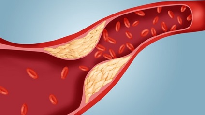 Hogyan lehet csökkenteni a vér koleszterin diéta koleszterincsökkentő