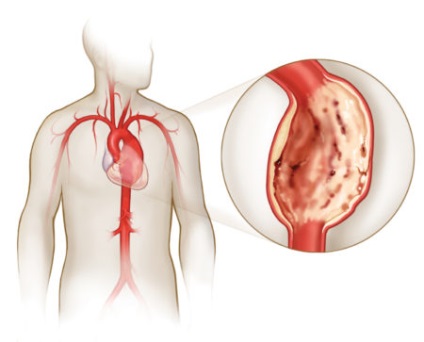 Meszesedés az aorta billentyű (szelep) Meszesedés az aorta billentyű