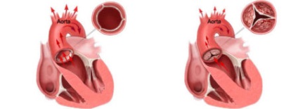 Meszesedés az aorta billentyű