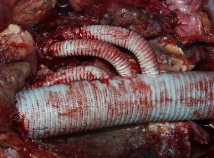 Meszesedés az aorta billentyű meszesedés az aorta (kezelés)