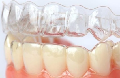 Capa fogászati ​​fogak - típusok, alkalmazása és karbantartása