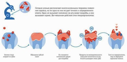 Caries típusok, tünetei, kezelési eljárásokat caries fogtömés fogszuvasodást megelőző