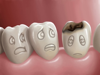 Caries típusok, tünetei, kezelési eljárásokat caries fogtömés fogszuvasodás megelőzésére (fogszuvasodás) Caries típusok, tünetei, kezelési eljárásokat caries fogtömés fogszuvasodást megelőző
