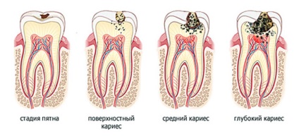 Fogszuvasodás típusok, tünetei, kezelési eljárásokat caries fogtömés fogszuvasodást megelőző (kezelés) Caries típusok, tünetei, kezelési eljárásokat caries fogtömés fogszuvasodást megelőző