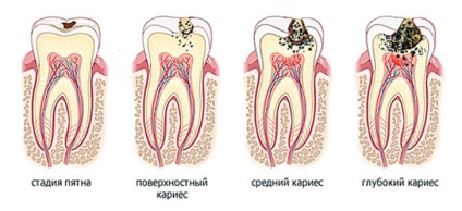 Caries típusok, tünetei, kezelési eljárásokat caries fogtömés fogszuvasodást megelőző