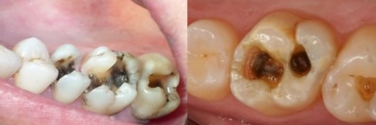 Caries típusok, tünetei, kezelési eljárásokat caries fogtömés fogszuvasodást megelőző