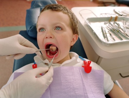 Caries típusok, tünetei, kezelési eljárásokat caries fogtömés fogszuvasodást megelőző