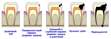 Caries típusok, tünetei, kezelési eljárásokat caries fogtömés fogszuvasodást megelőző