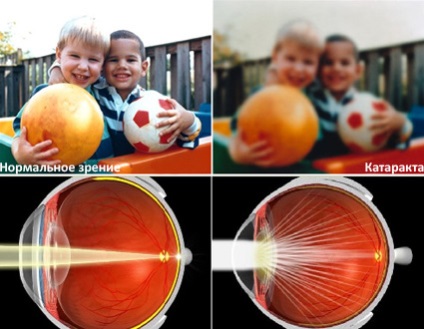 Cataract szem jelek, tünetek megelőzése