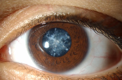 Cataract szem jelek, tünetek megelőzése