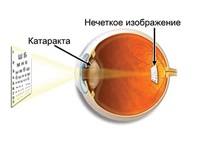 Cataract okoz, tünetei, kezelése és megelőzése, a szem és a látás