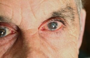 Cataract okoz, tünetei, kezelése és megelőzése, a szem és a látás