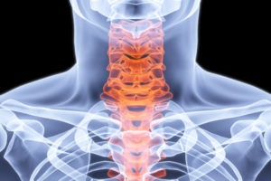 Kyphosis a nyaki gerinc kezelésére, patológiai gyakorolja kezelésére